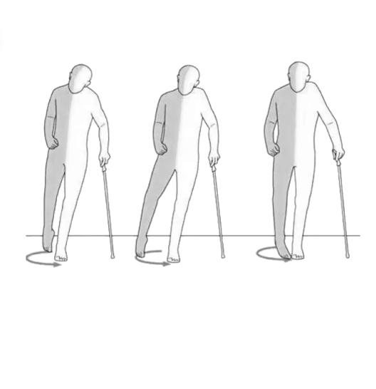 步态矫正示意图